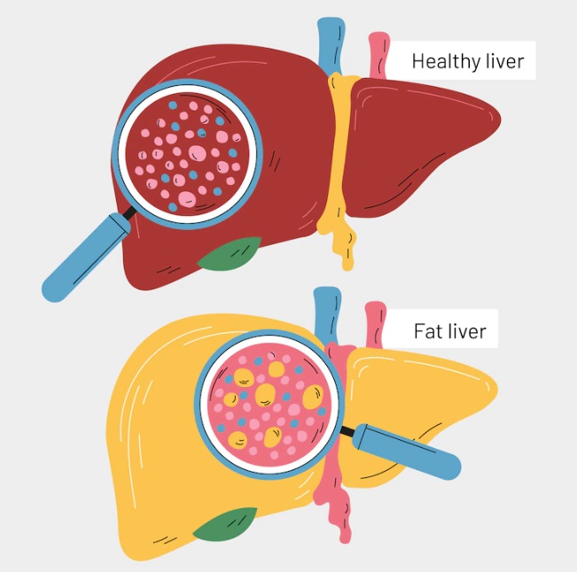 کبد چرب چیست؟