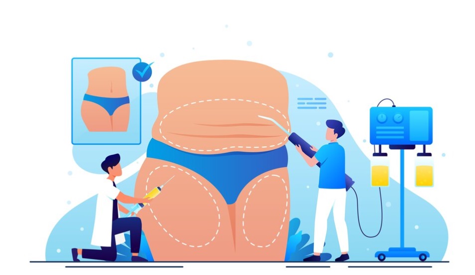 لیپوساکشن به کمک امواج اولتراسوند High-Intensity-Focused Ultrasound