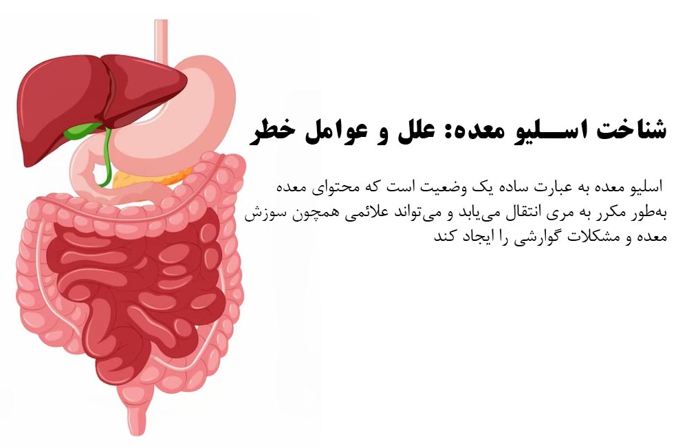 علائم اسلیو معده: علل و عوامل خطر علائم اسلیو معده: علل و عوامل خطر